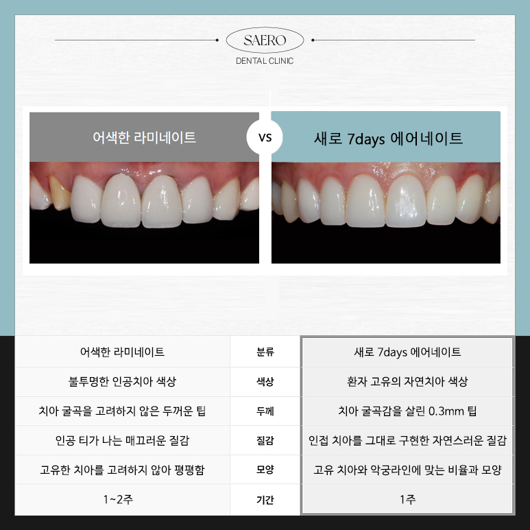 에어네이트의 특별함 (라미네이트 대체 시술) 관련 이미지 4