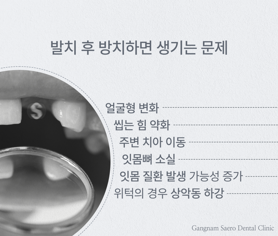 임플란트기간 최대 6개월 단축 20대 30대에게 추천하는 (최단기임플란트) 관련 이미지 2