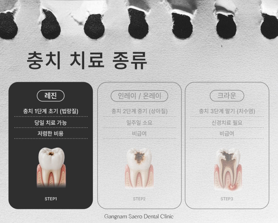 Types and Materials of Dental Caries Treatment by Stage (Types of Cavity Treatment) image 5