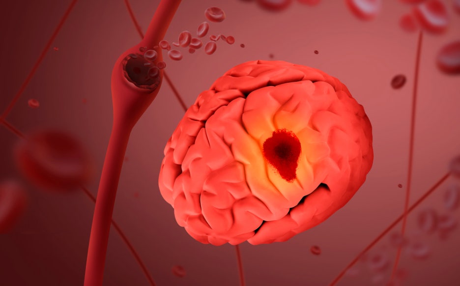 Warning Signs of Cerebral Hemorrhage, Why It Is Even More Dangerous in the Cold Winter, and Treatment Methods image 4