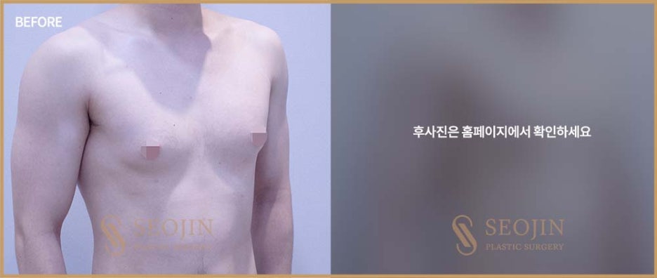강남역 여유증수술 필요한 경우는? 관련 이미지 6