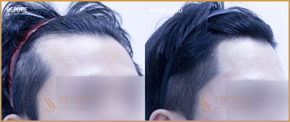 서진 모발이식수술 원리 통증 정리 관련 이미지 2