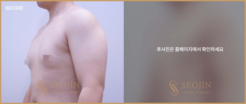강남역 여유증수술 필요한 경우는? 관련 이미지 4
