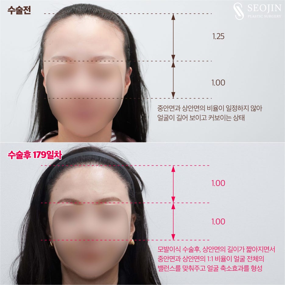 헤어라인모발이식 잘하는곳 내게 딱 맞는 비율로 관련 이미지 5