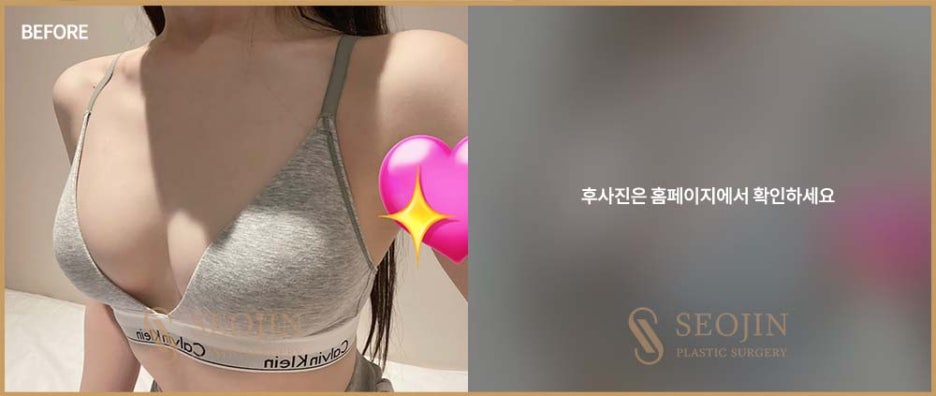 Learn About Breast Implant Types for Breast Surgery in Apgujeong image 5