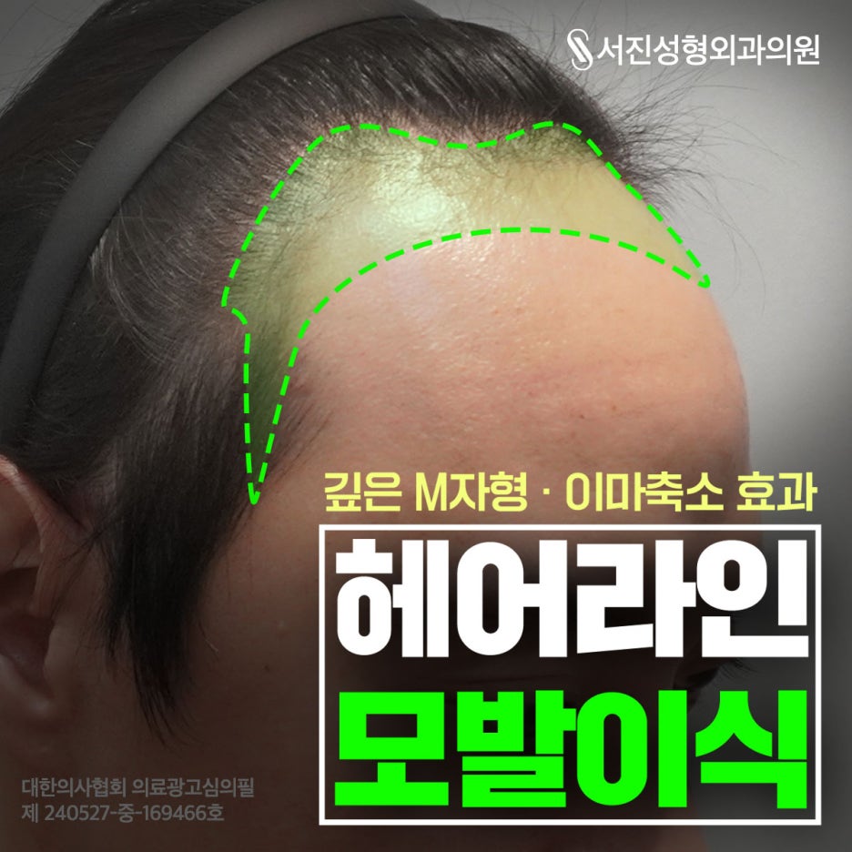 신사 모발이식, 절개와 비절개는 무엇이 다를까 관련 이미지 6