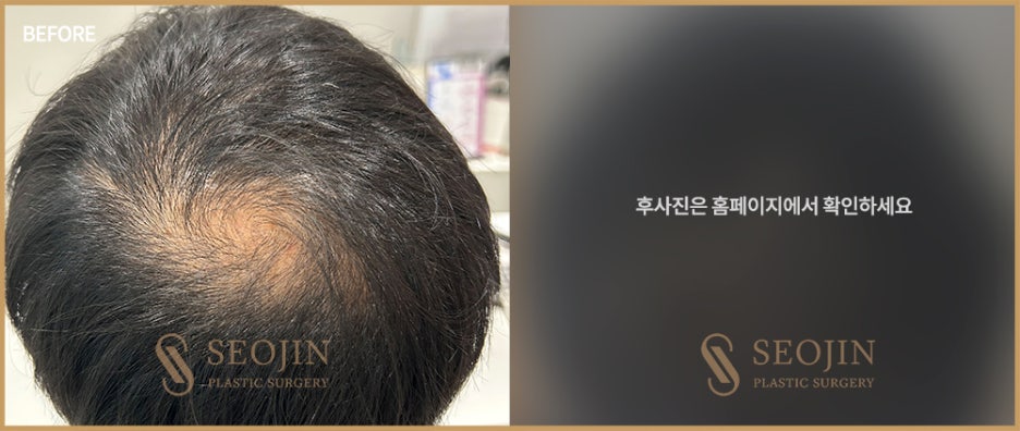 신사역 모발이식수술 탈모인을 위한 정보 관련 이미지 3