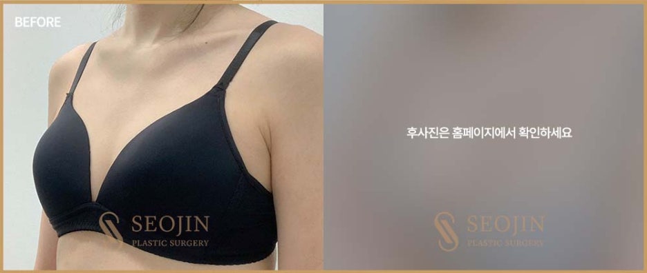 서진성형외과 처진가슴 원인에 대해 알아봐요 관련 이미지 5