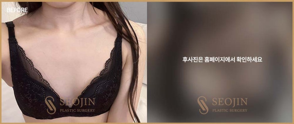 Learn About Breast Implant Types for Breast Surgery in Apgujeong image 3