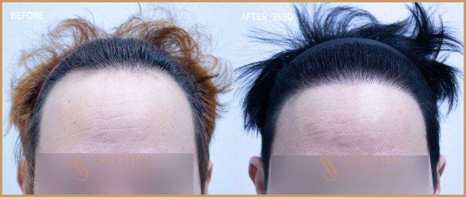 모발이식 무삭발 노컷으로 그대로 티 안나게 관련 이미지 4