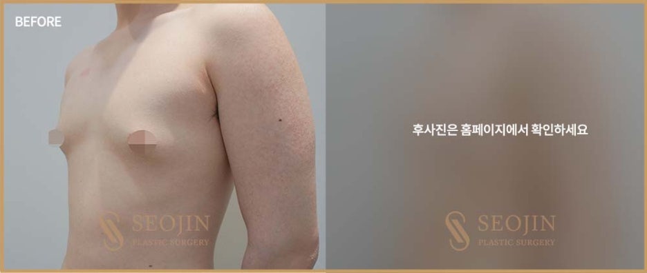 강남역 여유증수술 필요한 경우는? 관련 이미지 3