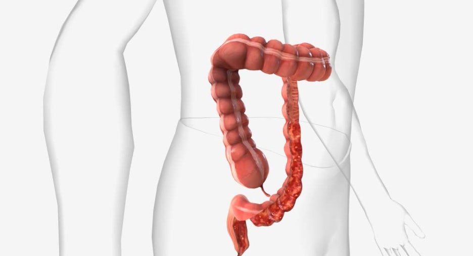 대장내시경 전날 음식 카스테라 바나나 커피 먹어도 될까요 관련 이미지 2