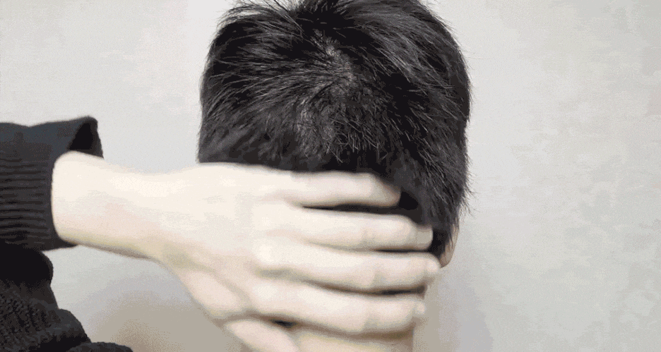 모발이식 절개법 vs 비절개법 분석 결과는? 관련 이미지 5