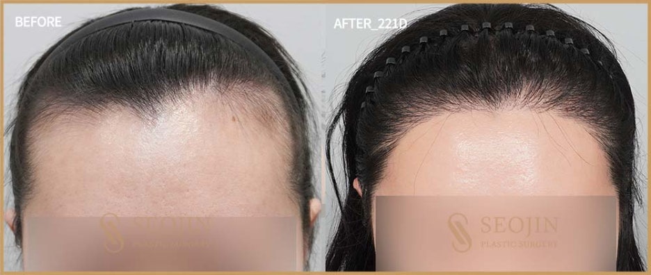 헤어라인모발이식 잘하는곳 내게 딱 맞는 비율로 관련 이미지 4