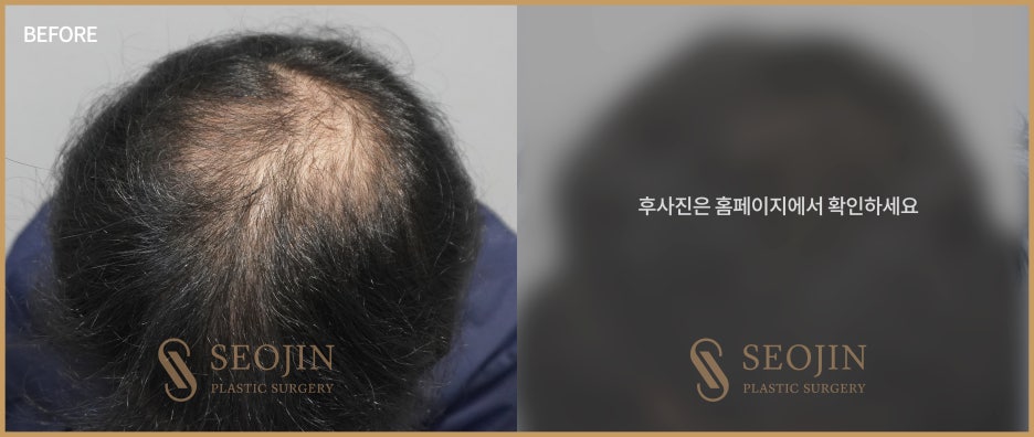 신사역 모발이식수술 탈모인을 위한 정보 관련 이미지 6