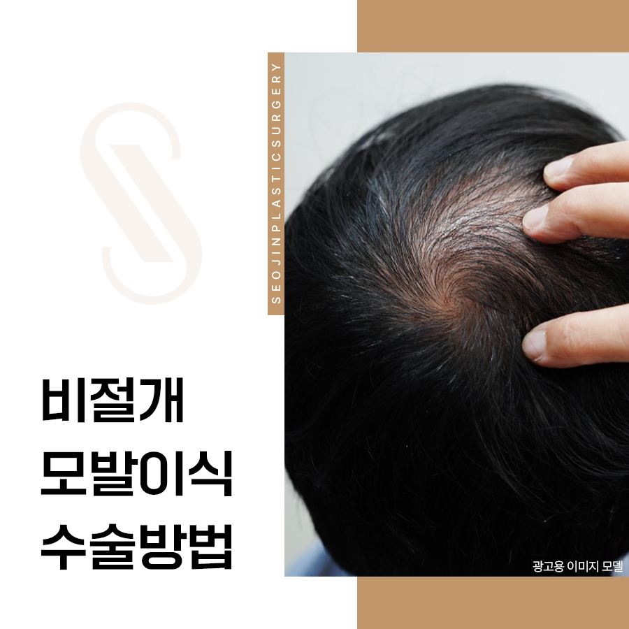 비절개모발이식수술방법 절개방법과 차이 관련 이미지 1