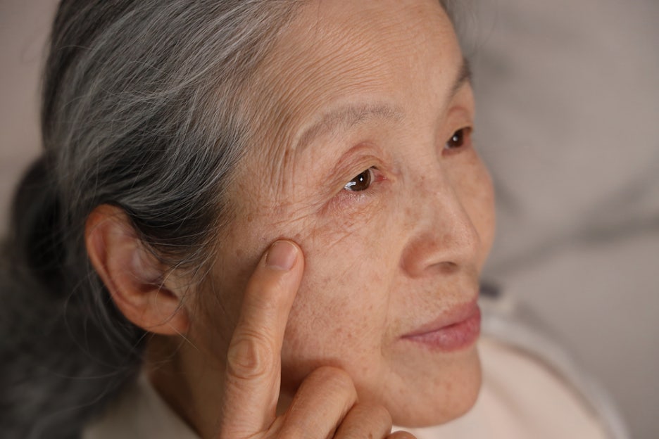 한관종 비립종 차이점, 이제 헷갈리지 마세요! 원인부터 증상, 제거 방법 관련 이미지 6