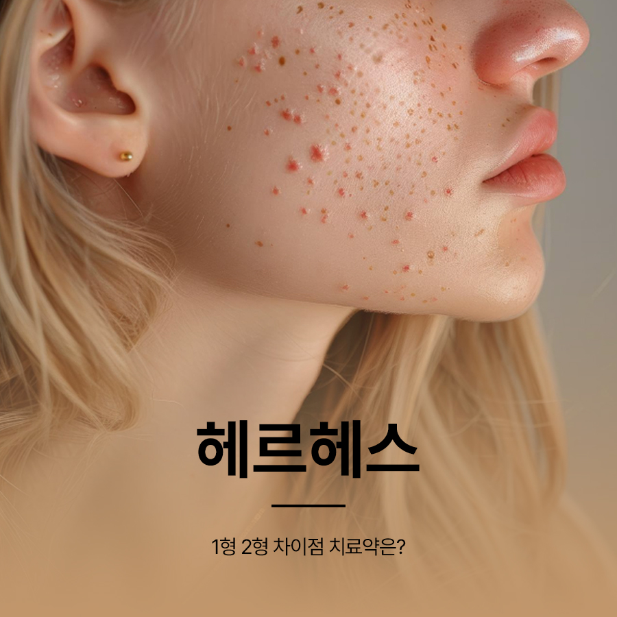 헤르페스 1형 2형 차이점 치료약은? 관련 이미지 1