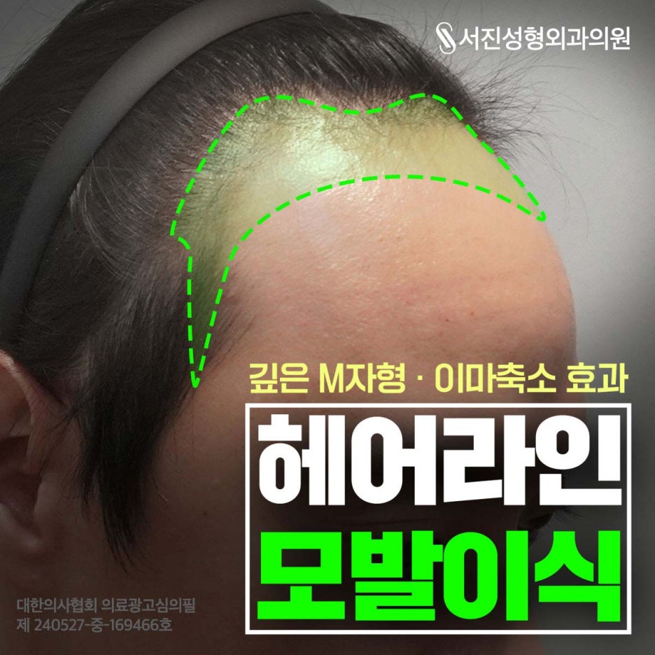 How to Improve Crown Hair Loss When Considering Hair Transplantation Near Apgujeong Station image 3