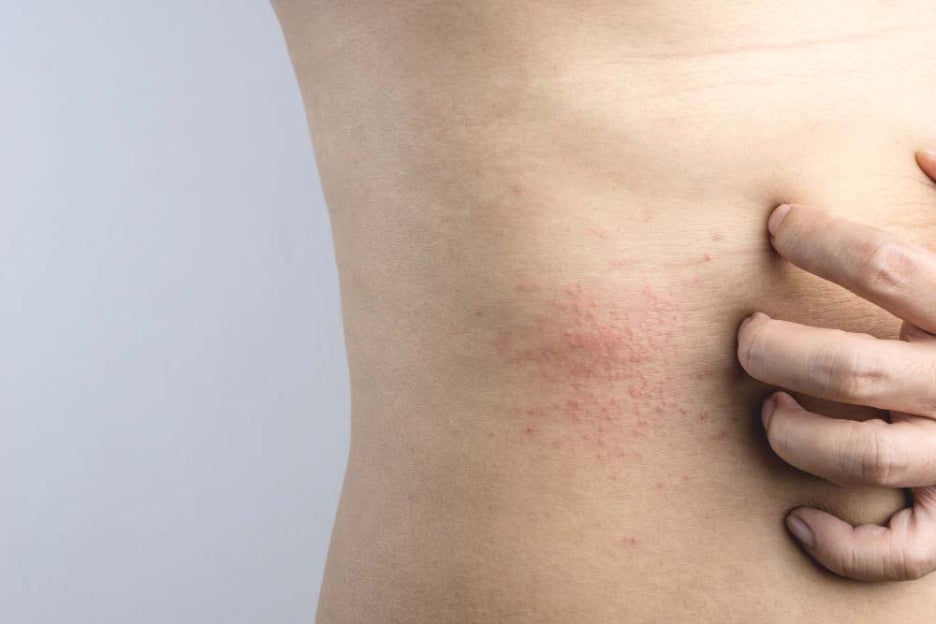 대상포진 수포없는 초기증상도 있어 주의사항 관련 이미지 4