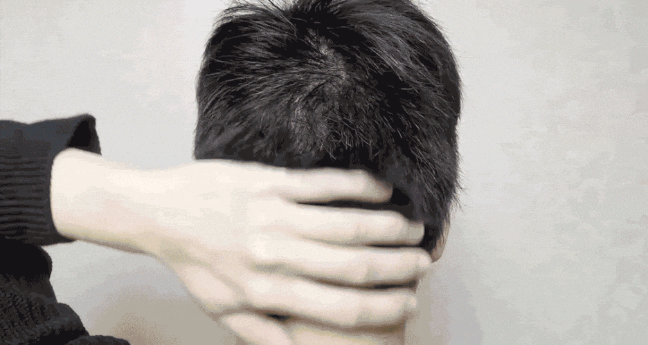 모발이식 비절개 무삭발 남여 자연스러운 결과 관련 이미지 4