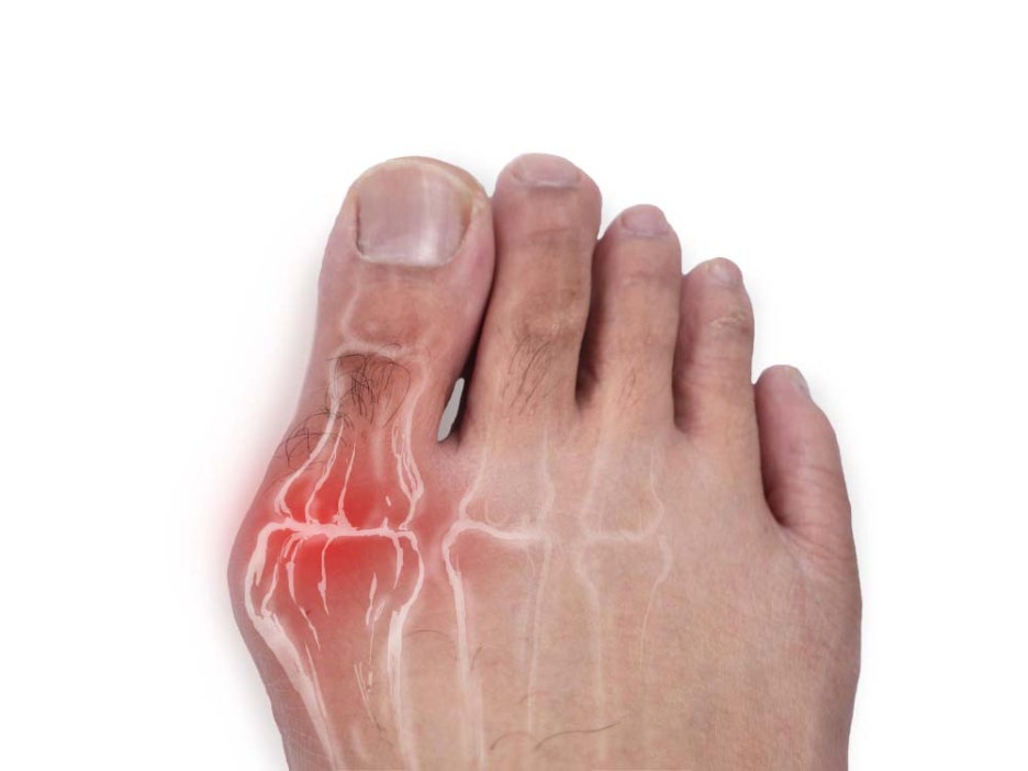 What Does Gout Mean? Toe Pain Symptoms and Foods Good for Gout image 2