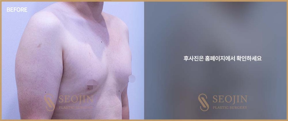 강남역 여유증수술 필요한 경우는? 관련 이미지 2