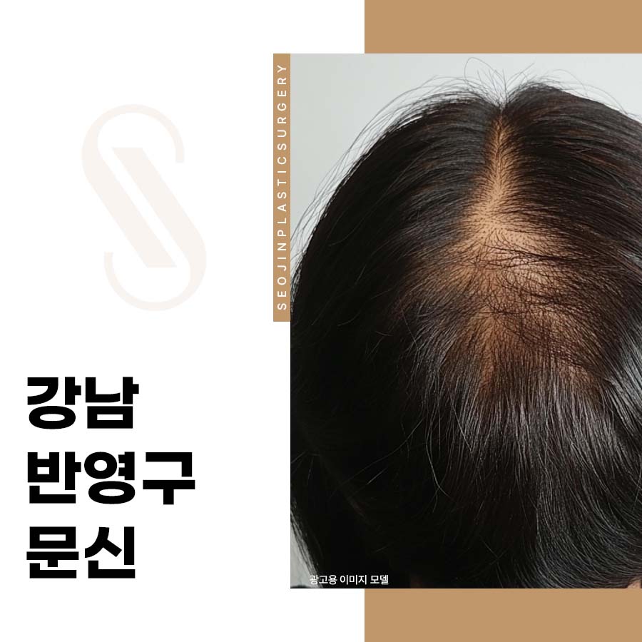 Gangnam Semi-Permanent Makeup: Naturally Concealing the Crown with Scalp Micropigmentation image 1