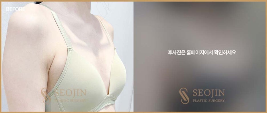 서진성형외과 처진가슴 원인에 대해 알아봐요 관련 이미지 3