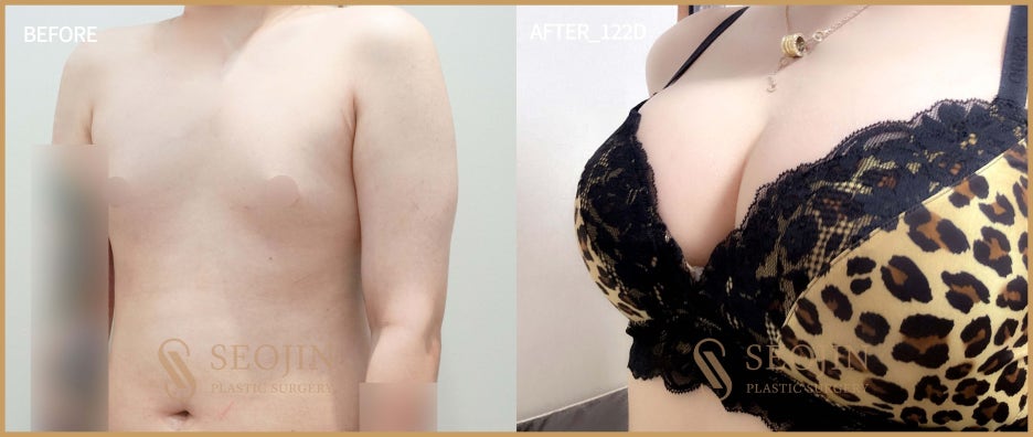 트랜스젠더 가슴성형(MTF 가슴수술) 난이도가 높으니까 관련 이미지 3