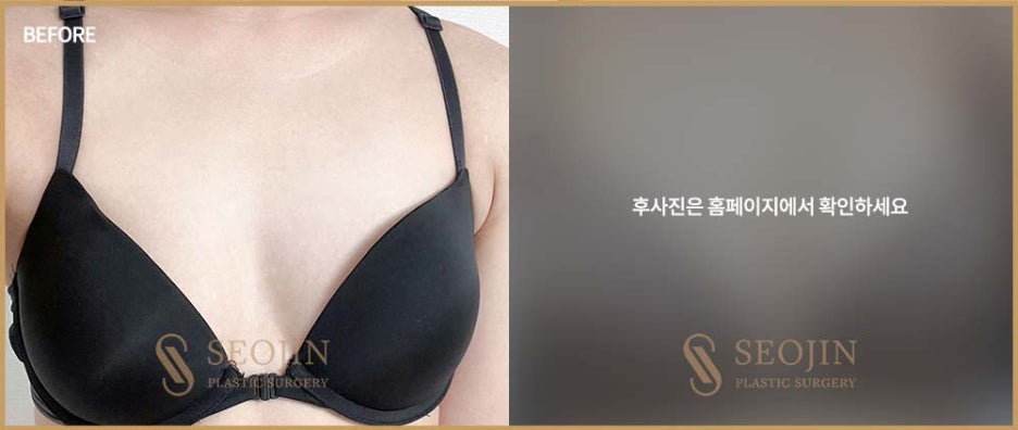 Learn About Breast Implant Types for Breast Surgery in Apgujeong image 6