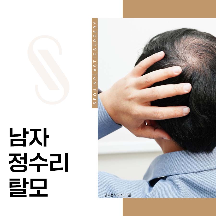 How Hair Transplant Can Help Improve Male Crown Hair Loss image 1