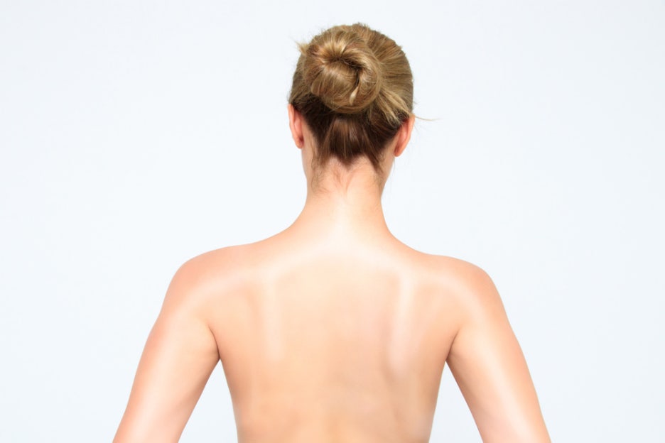 How to Get Rid of Back Acne: From Causes to Lifestyle Habits and Nape Acne image 6