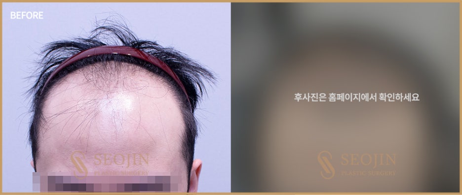 비절개모발이식수술방법 절개방법과 차이 관련 이미지 6