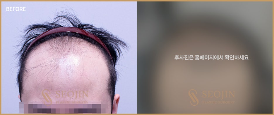 신사역 모발이식수술 탈모인을 위한 정보 관련 이미지 4