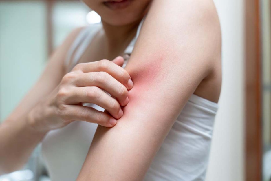What Are the Symptoms of Scabies Mites, Itching, and Treatment Methods? image 3