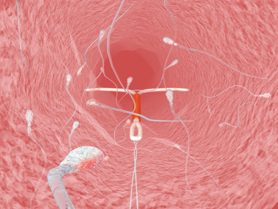 A Complete Guide to Mirena’s Contraceptive Effect: From Procedure to Precautions and Cost! image 4