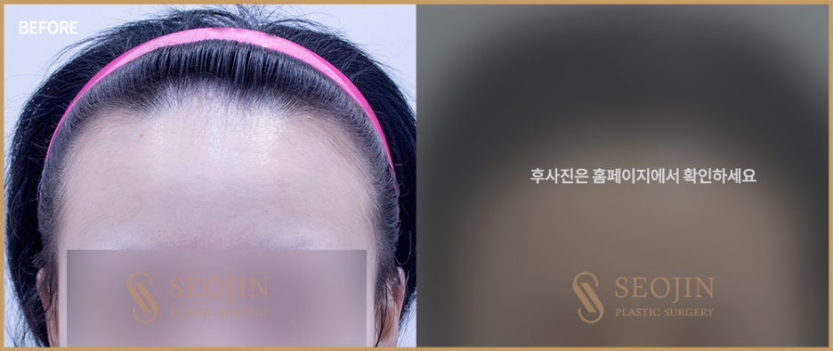 신사역 모발이식수술 탈모인을 위한 정보 관련 이미지 5