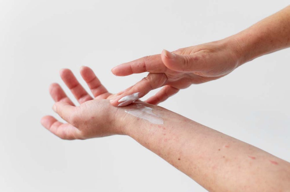 What Are the Symptoms of Scabies Mites, Itching, and Treatment Methods? image 4