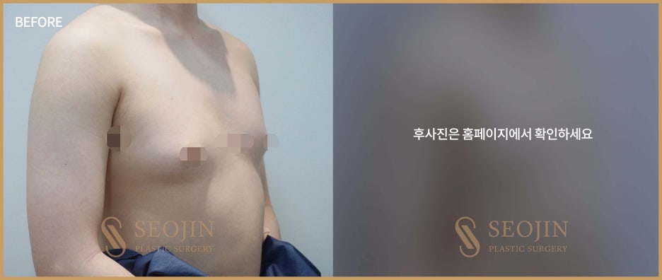 강남역 여유증수술 필요한 경우는? 관련 이미지 5