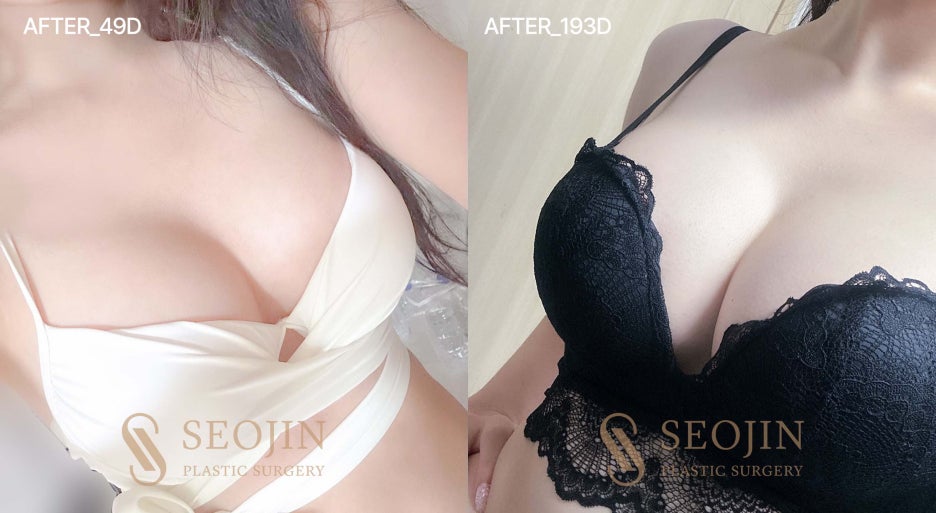 서진성형외과 가슴보형물 모티바 누워도 자연스러운 모습 관련 이미지 6