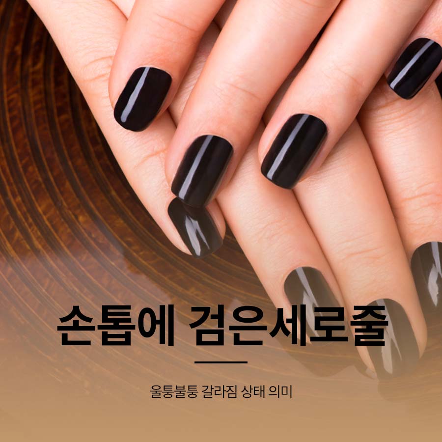 손톱에 검은 세로줄 울퉁불퉁 갈라짐 상태 의미 관련 이미지 1