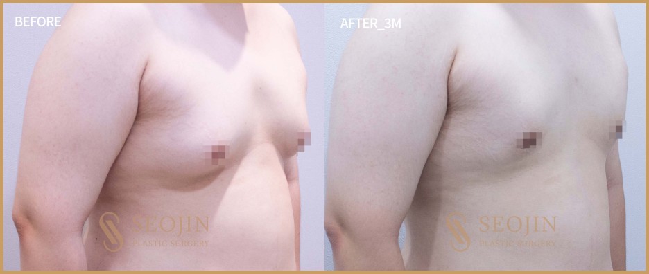 남자 여유증 치료정보 원인 종류 수술방법 분석 관련 이미지 1