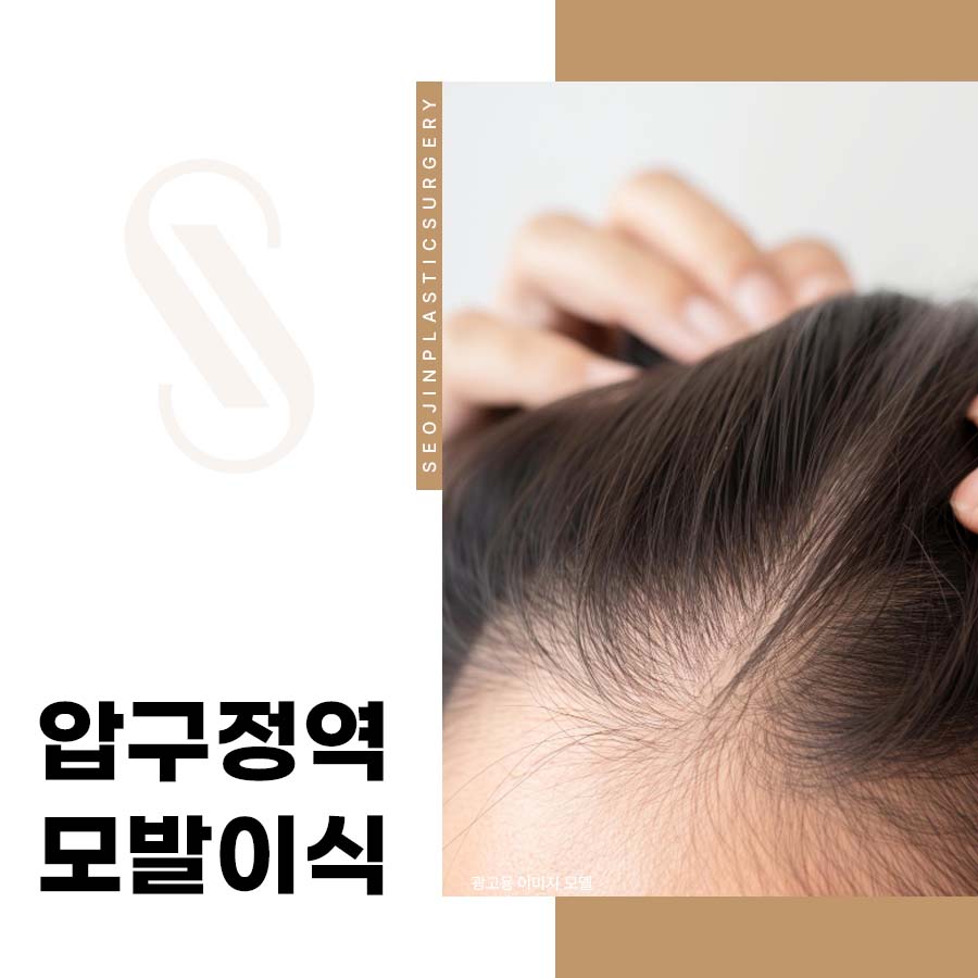 How to Improve Crown Hair Loss When Considering Hair Transplantation Near Apgujeong Station image 1