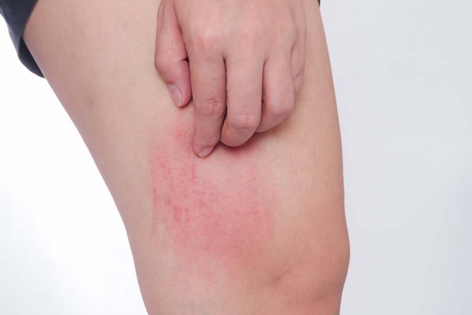 대상포진 증상 부위 치료 및 관리방법 관련 이미지 2