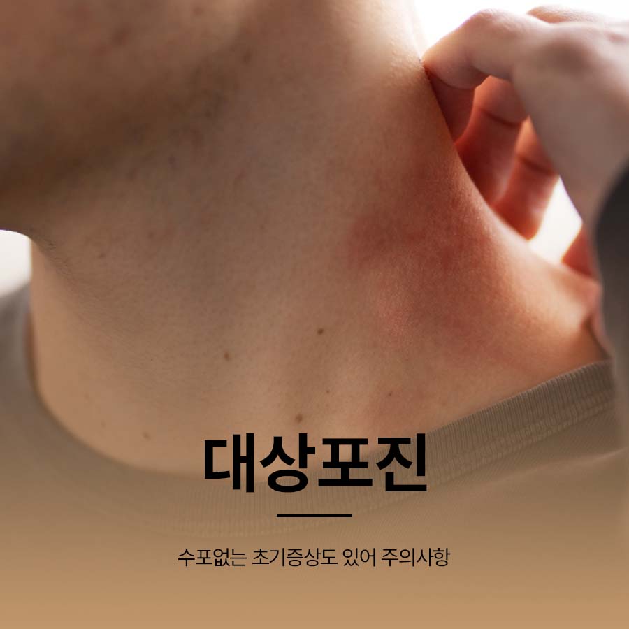 대상포진 수포없는 초기증상도 있어 주의사항 관련 이미지 1