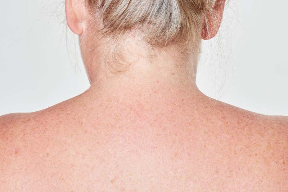 대상포진 수포없는 초기증상도 있어 주의사항 관련 이미지 3