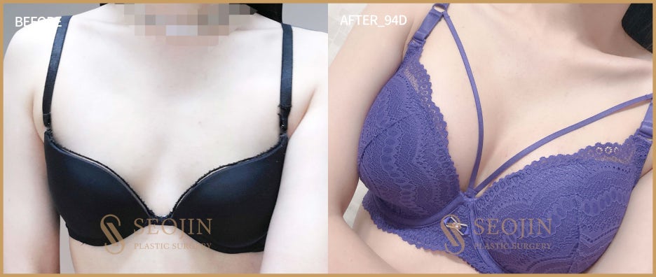 신사압구정 가슴성형 자연스러운 가슴 디자인으로 관련 이미지 1