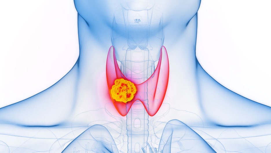 Thyroid Cancer Symptoms: Start by Checking for Changes in Your Neck image 4