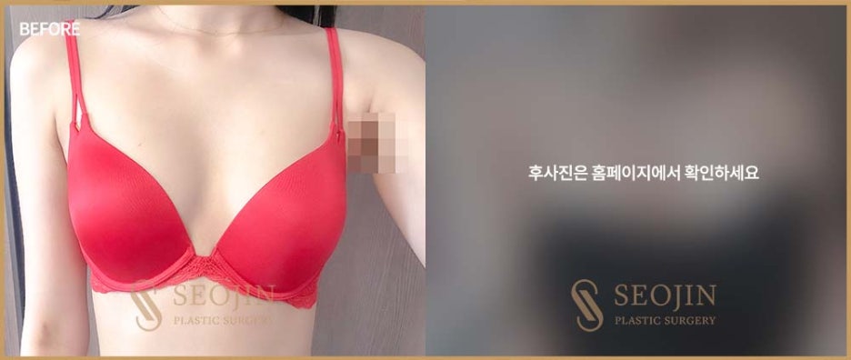 Learn About Breast Implant Types for Breast Surgery in Apgujeong image 4